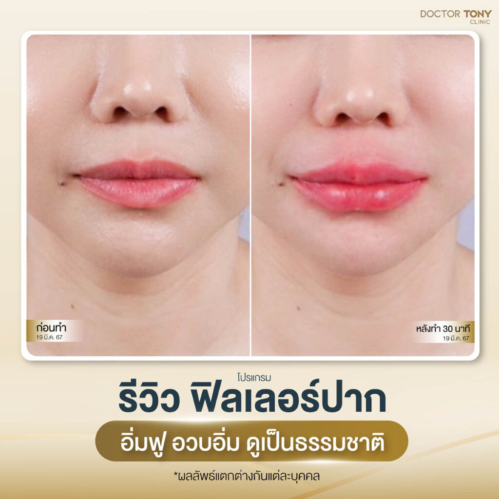 รีวิวฟิลเลอร์ปาก