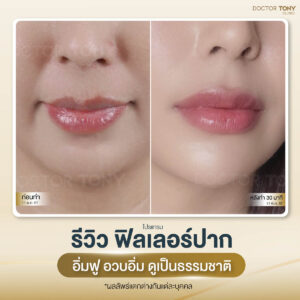 รีวิวฟิลเลอร์ปาก