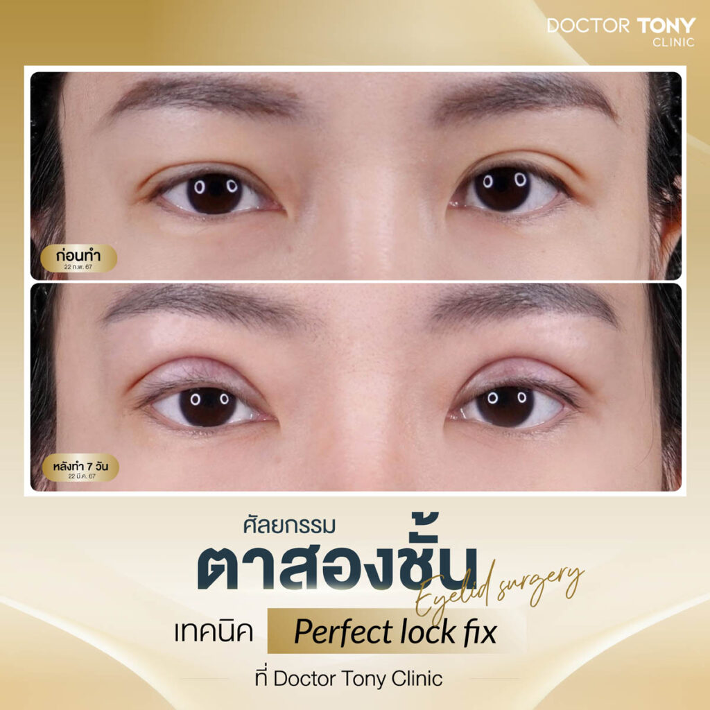 รีวิว ตาสองชั้น 9