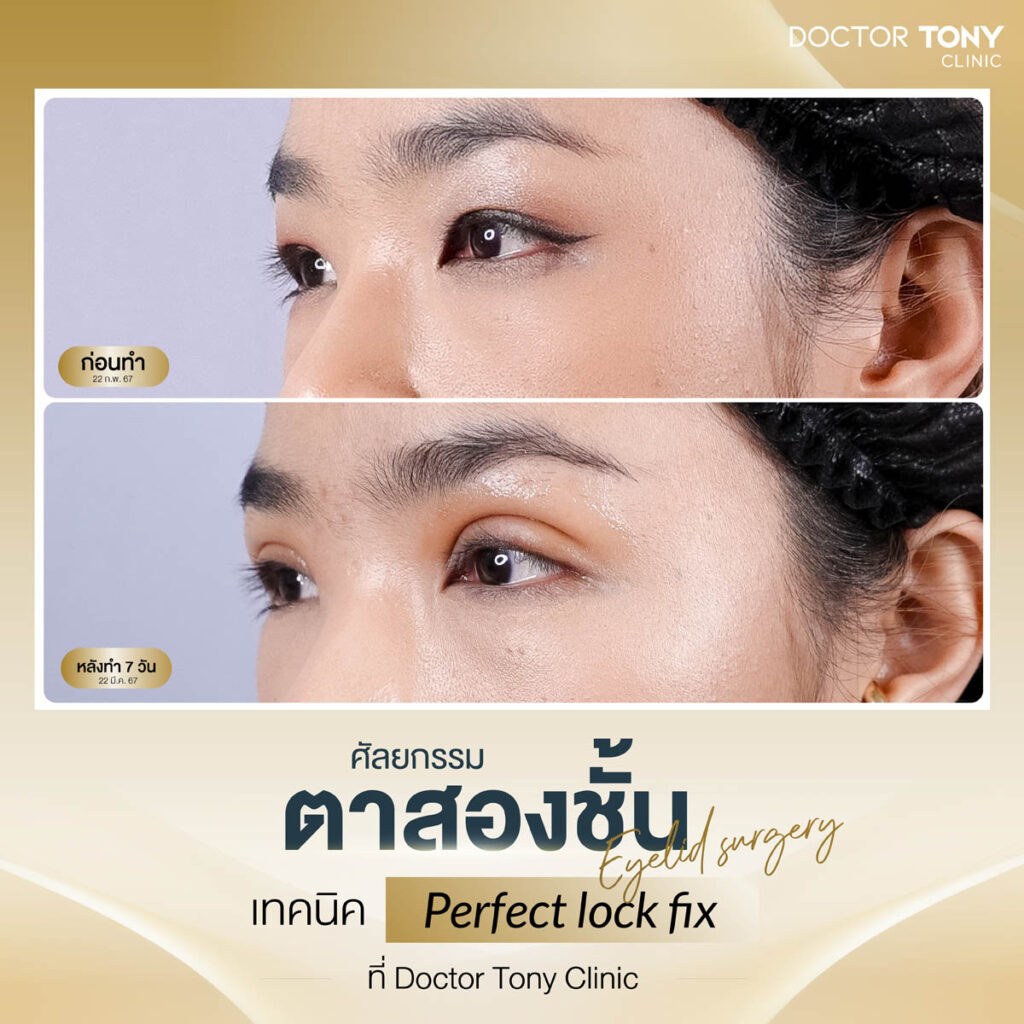 รีวิว ตาสองชั้น 4