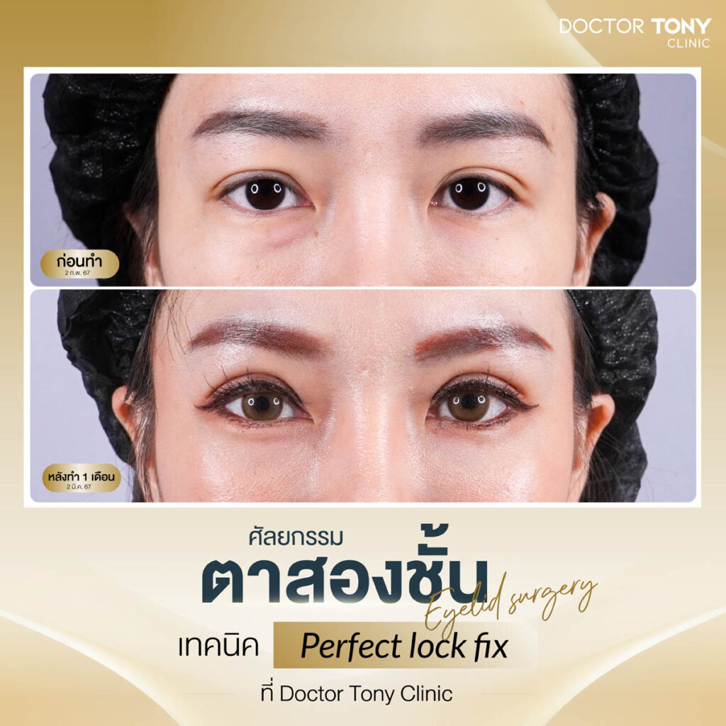 รีวิว ตาสองชั้น 2