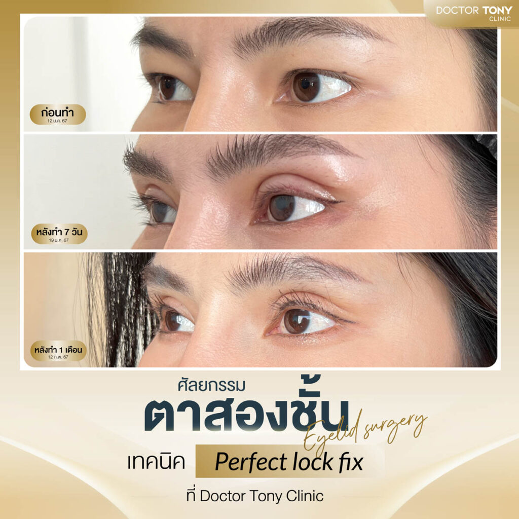 รีวิว ตาสองชั้น 1