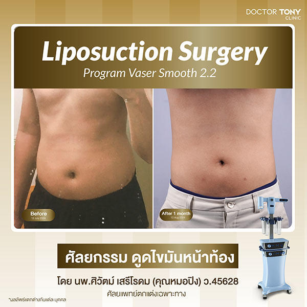 ดูดไขมันหน้าท้อง