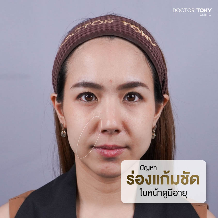 รีวิว ฉีดฟิลเลอร์ ร่องแก้ม 3