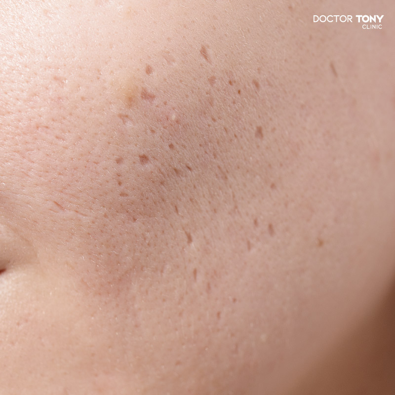 หลุมสิว