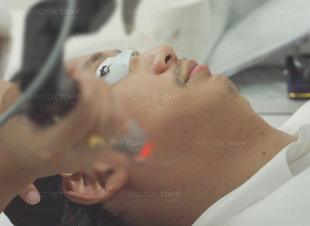 รักษาฝ้า ด้วยเลเซอร์