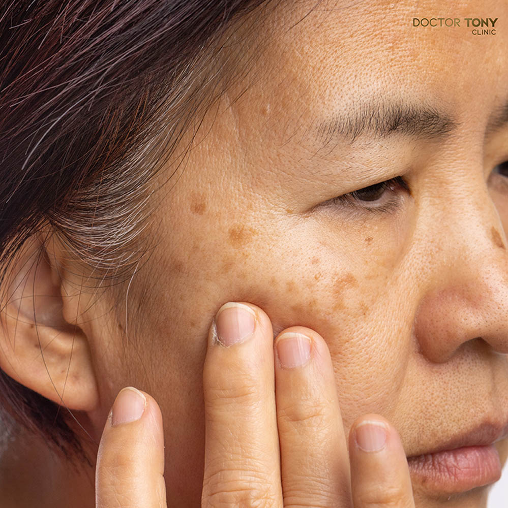 รักษาฝ้า