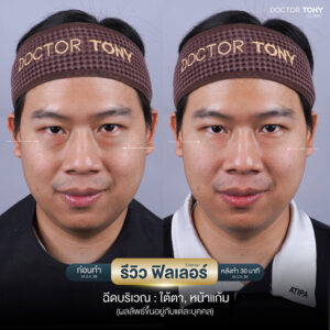 รีวิว ฟิลเลอร์ใต้ตา