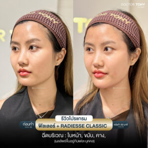 รีวิว ฟิลเลอร์คาง