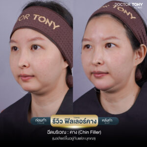 รีวิว ฟิลเลอร์คาง