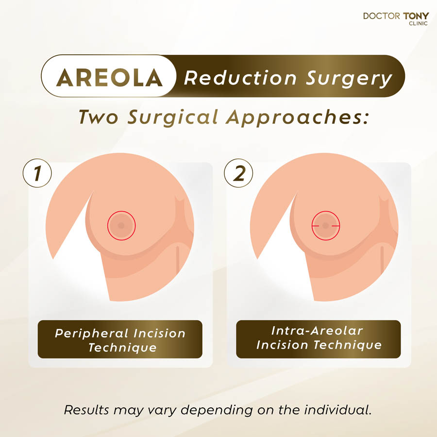 areola reduction surgery