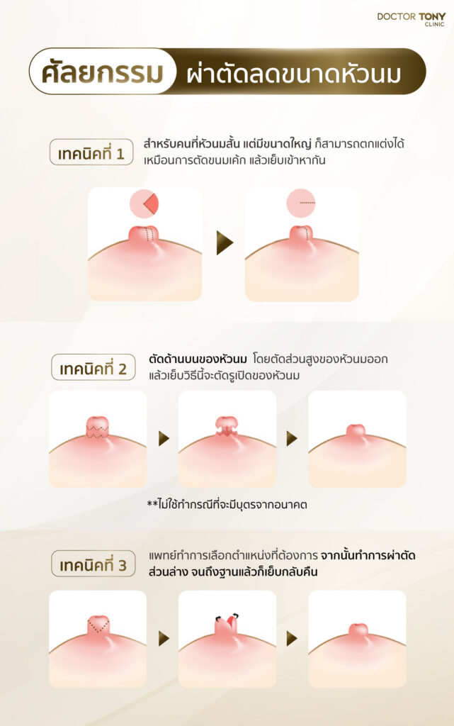 ขั้นตอนการ ลดขนาดปาน