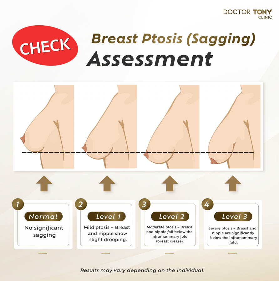 breast r ptosis sagging assessment