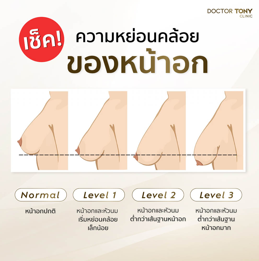 เช็คความหย่อนคล้อยหน้าอก