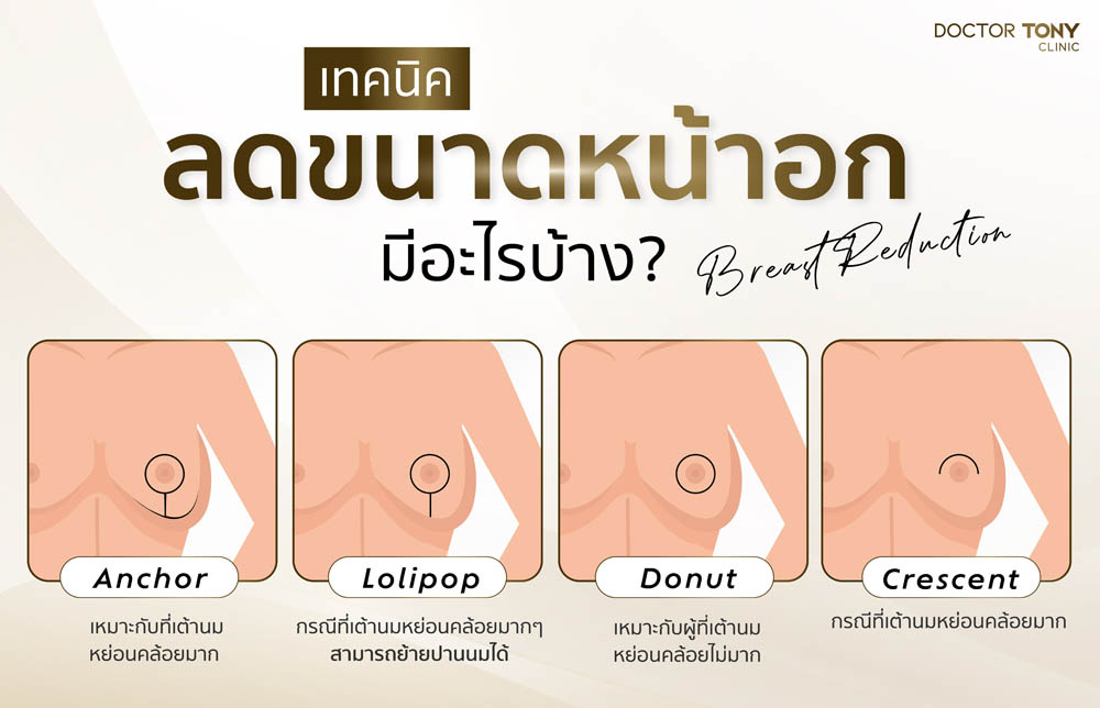 ผ่าตัดลดขนาดหน้าอก มีวิธีไหนบ้าง