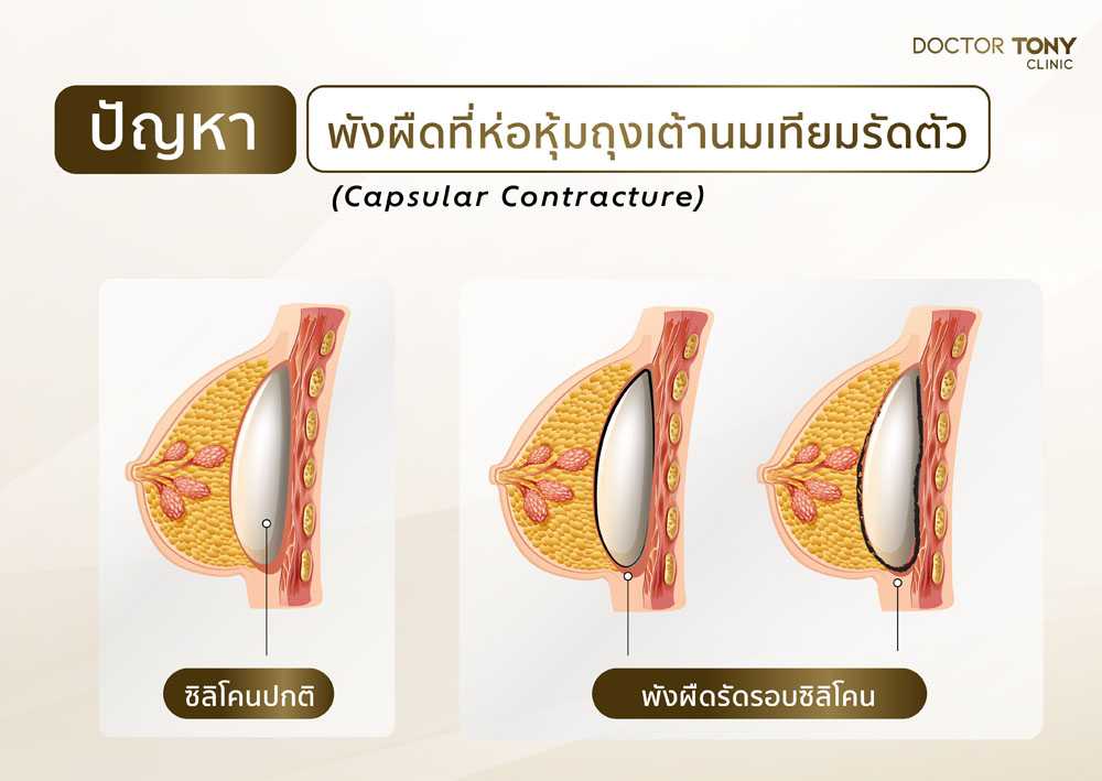 ผังผืดรัดซิลิโคน