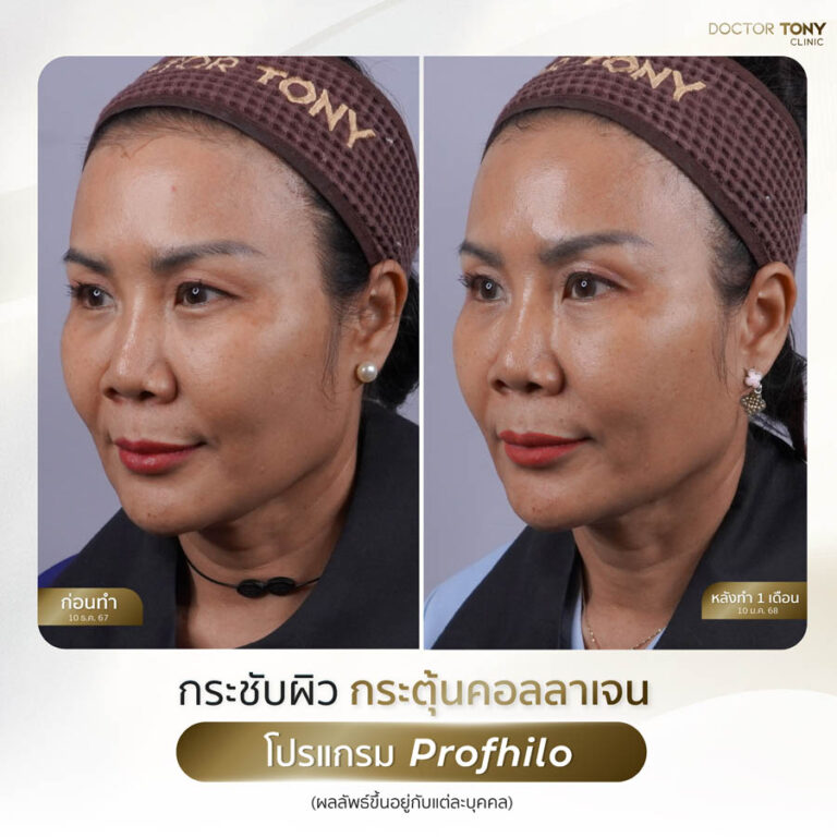 รีวิว Phofhilo 5