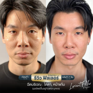 รีวิว ฟิลเลอร์ lorient 3