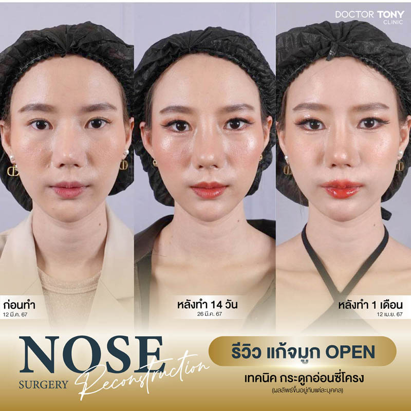 รีวิว เสริมจมูกโอเพ่น 45