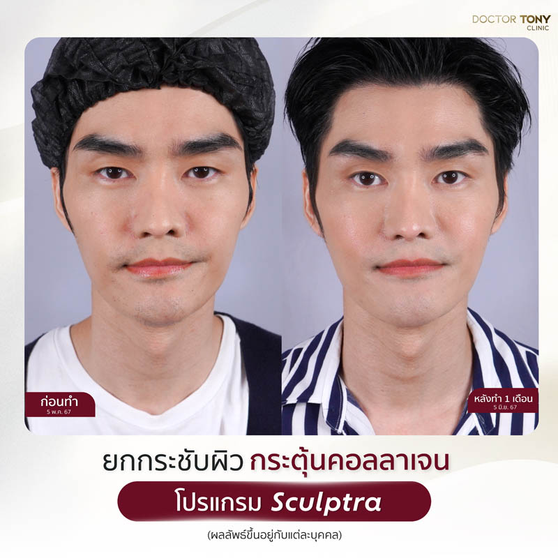 sculptra รีวิว (review) 9