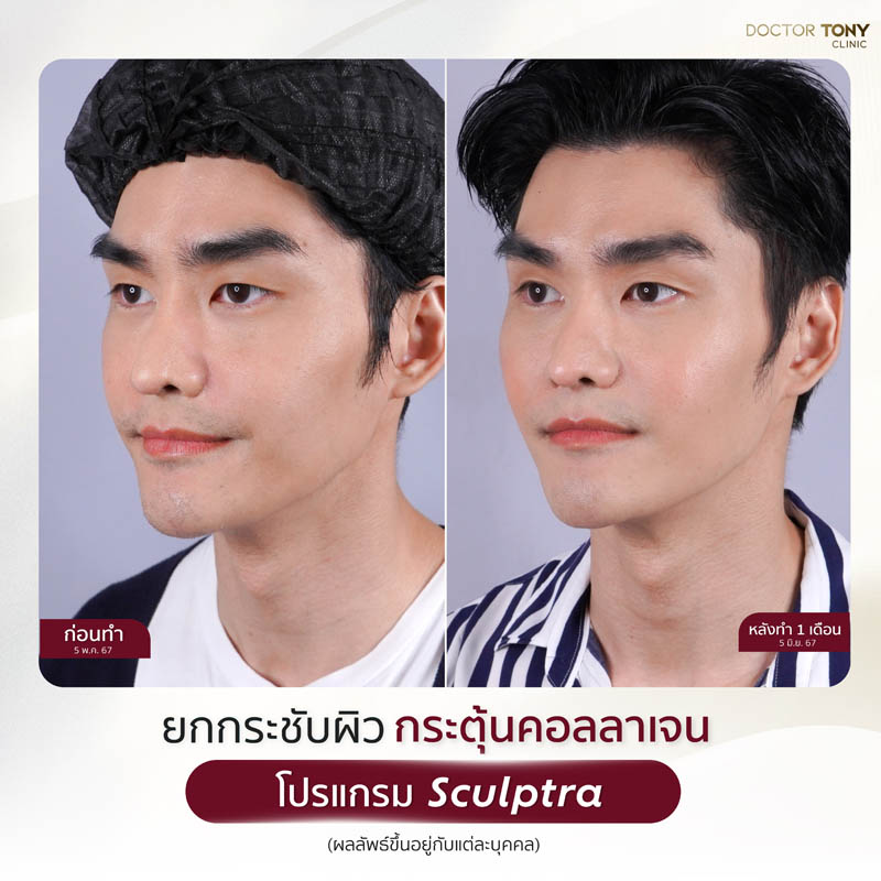sculptra รีวิว (review) 10