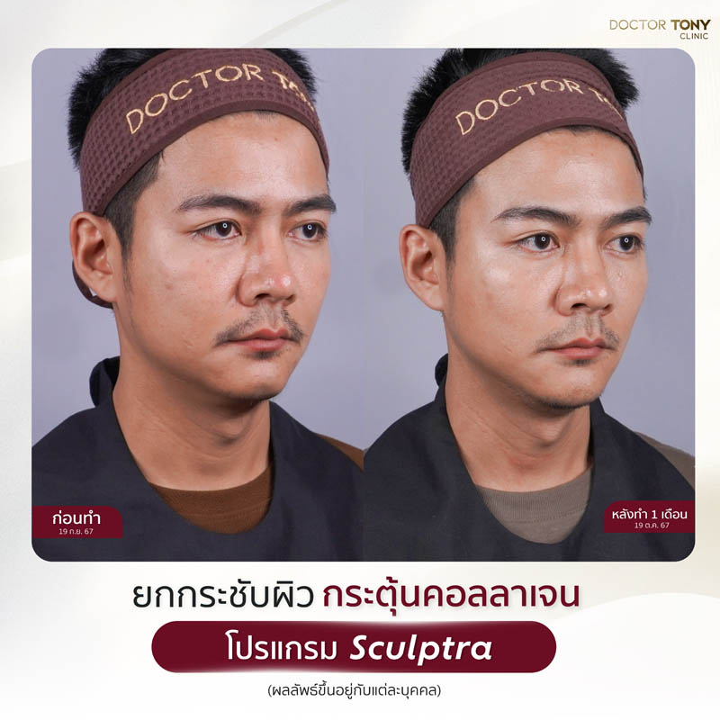sculptra รีวิว (review) 13