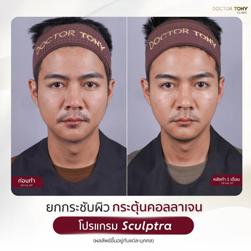 sculptra รีวิว (review) 18