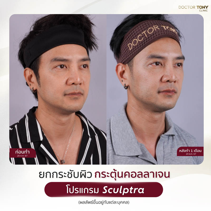 sculptra รีวิว (review) 19