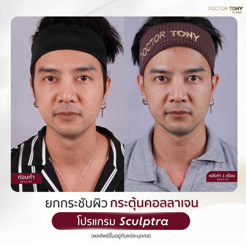 sculptra รีวิว (review) 20