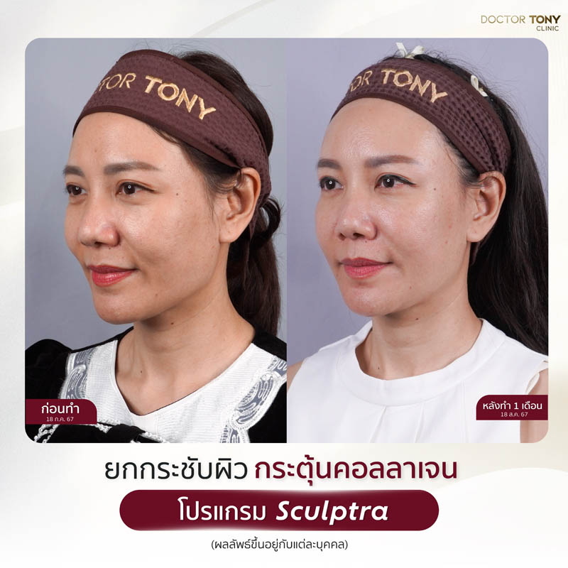 sculptra รีวิว (review) 23