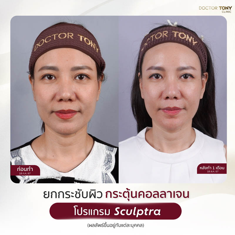 sculptra รีวิว (review) 24