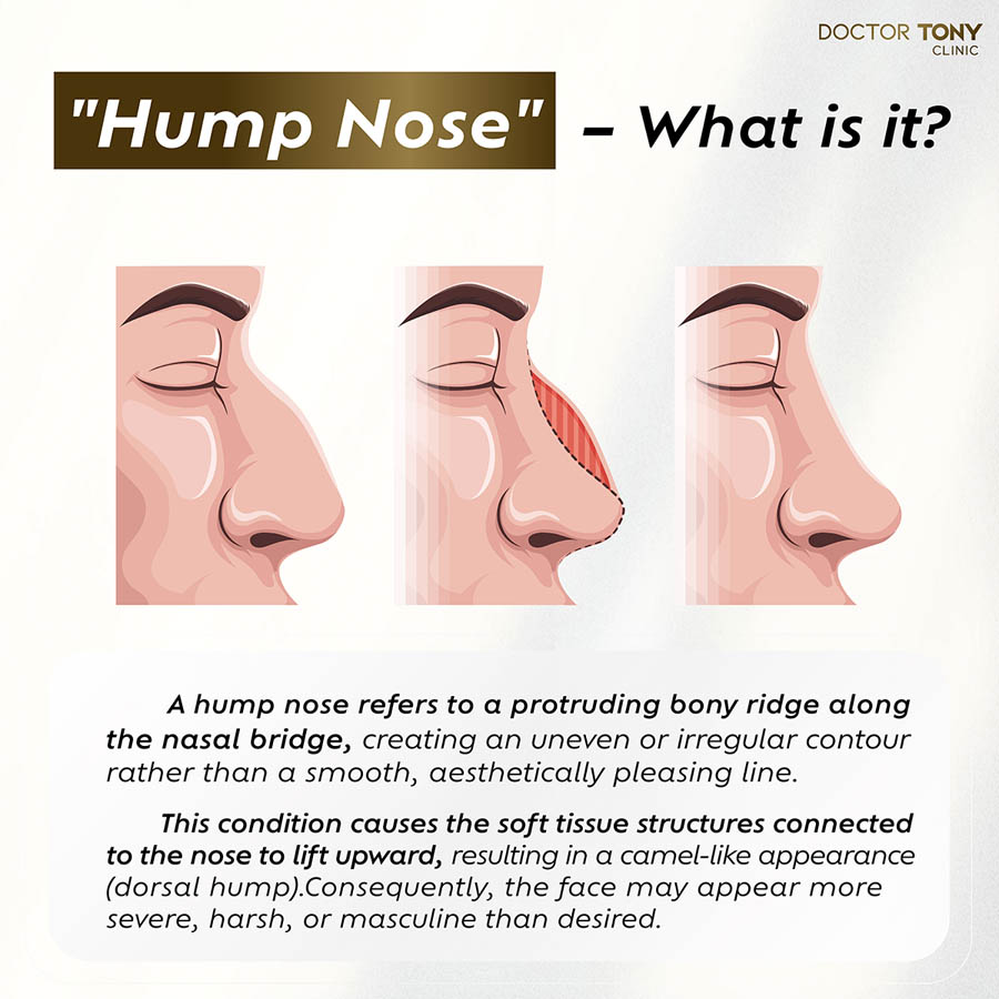 hump nose