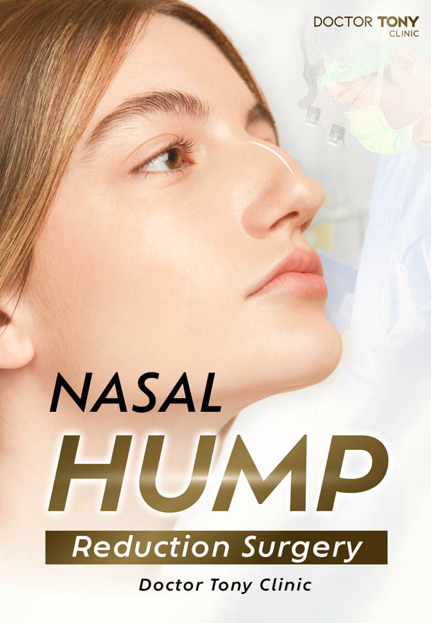 nasal hump 1