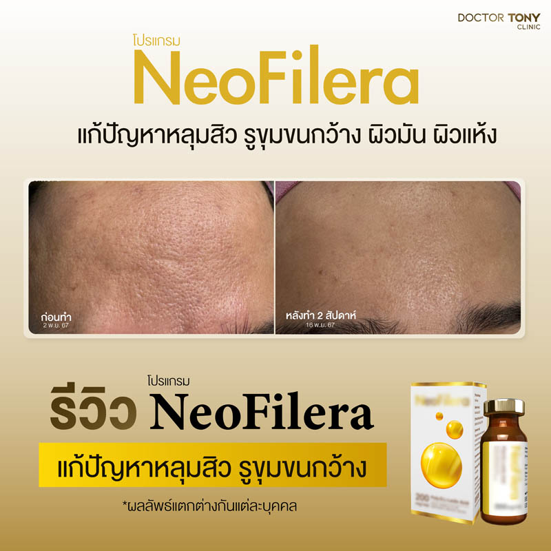 รีวิว NeoFilera 11