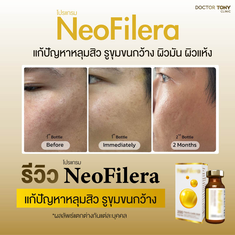 รีวิว NeoFilera 10