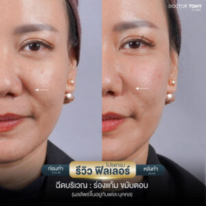 รีวิวฟิลเลอร์ร่องแก้ม 11