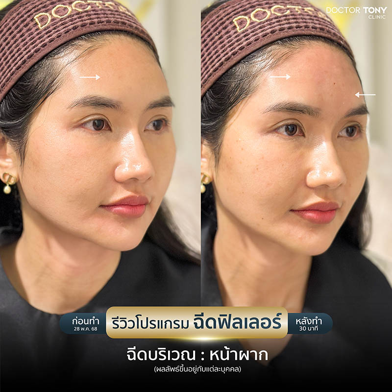 รีวิว ฟิลเลอร์หน้าผาก