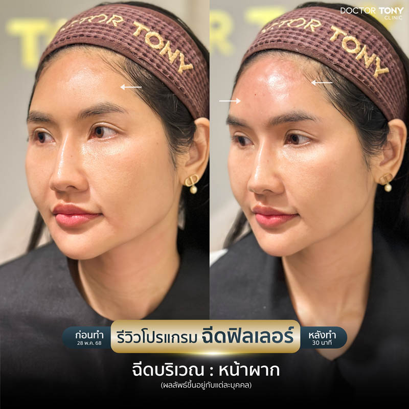 รีวิว ฟิลเลอร์หน้าผาก 1
