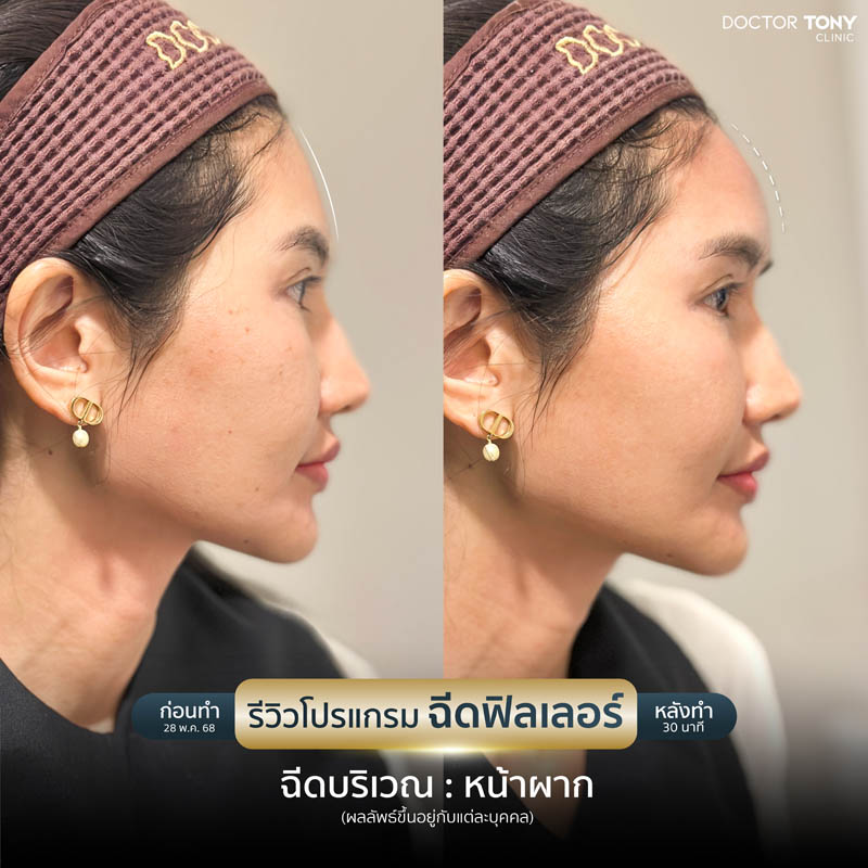 รีวิว ฟิลเลอร์หน้าผาก 2
