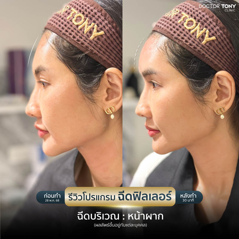 รีวิว ฟิลเลอร์หน้าผาก 3