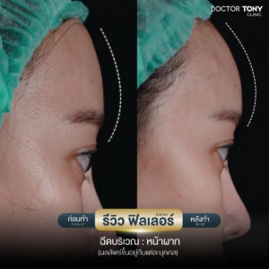 รีวิวฟิลเลอร์หน้าผาก 5