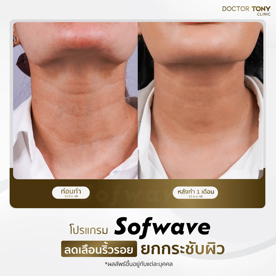 รีวิว sofwave 3