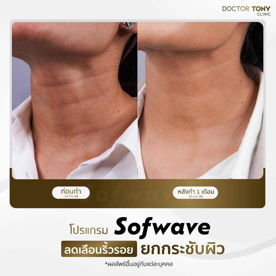 รีวิว sofwave 4