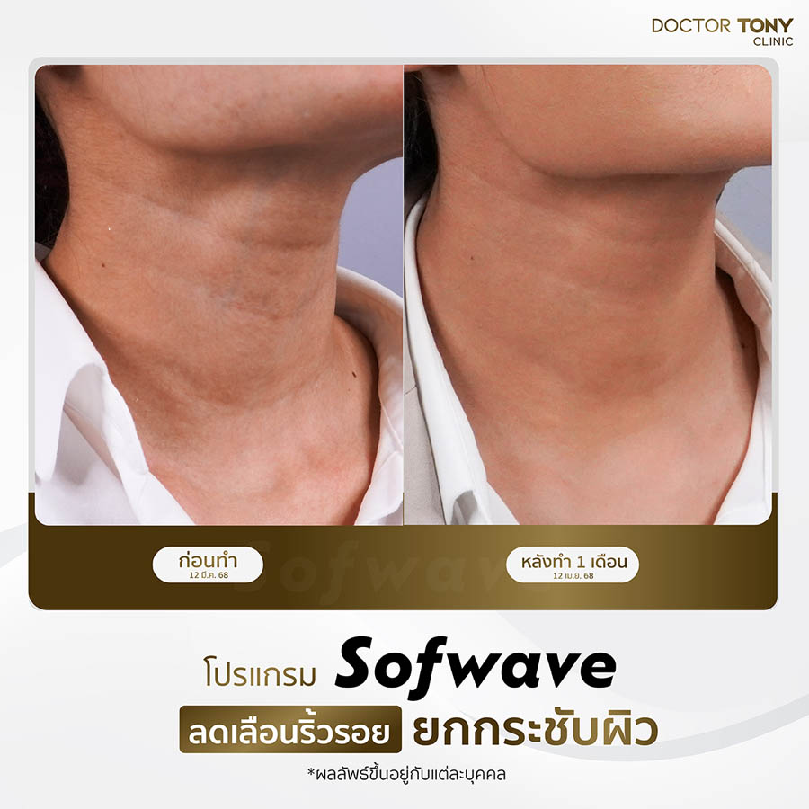 รีวิว sofwave 5