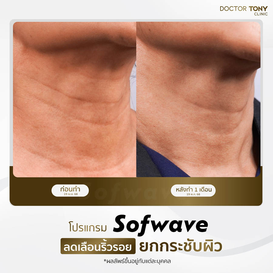 รีวิว sofwave 1