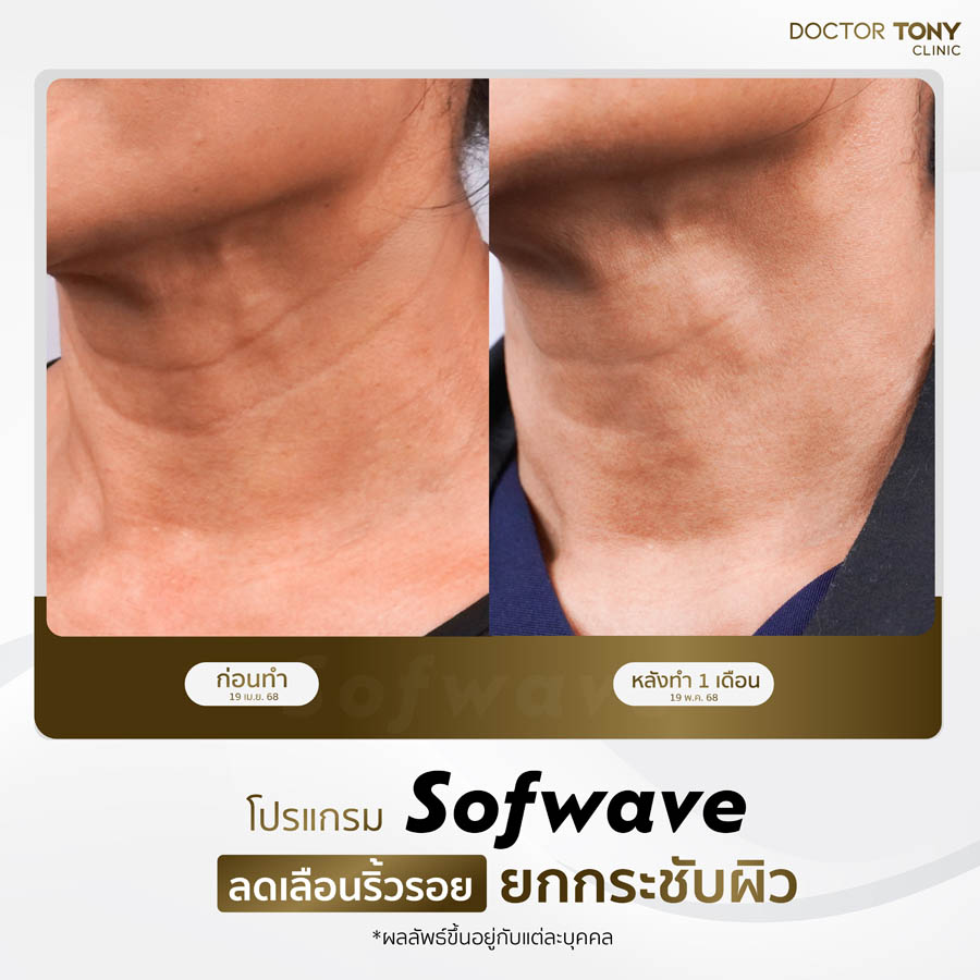 รีวิว sofwave 2