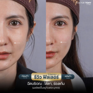 รีวิวฟิลเลอร์ร่องแก้ม 10