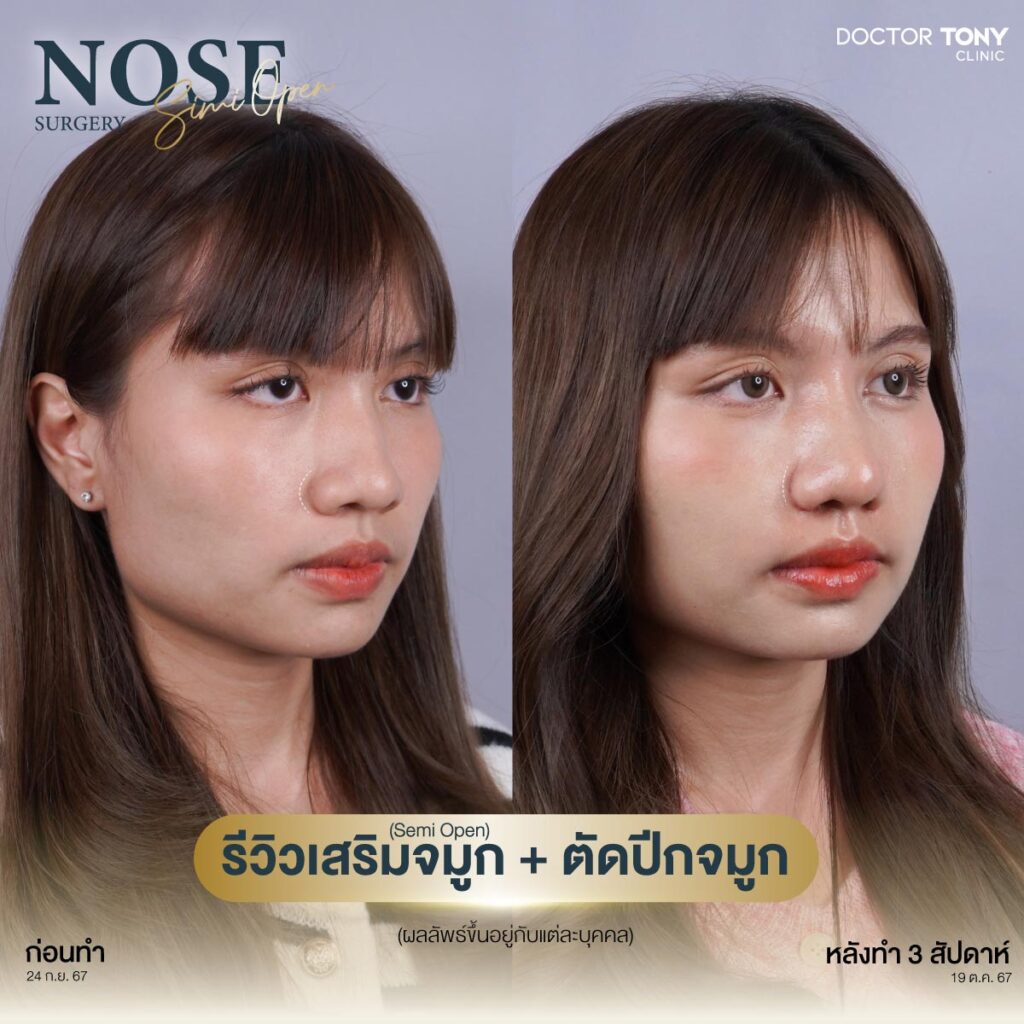 รีวิว ตัดปีกจมูก 1