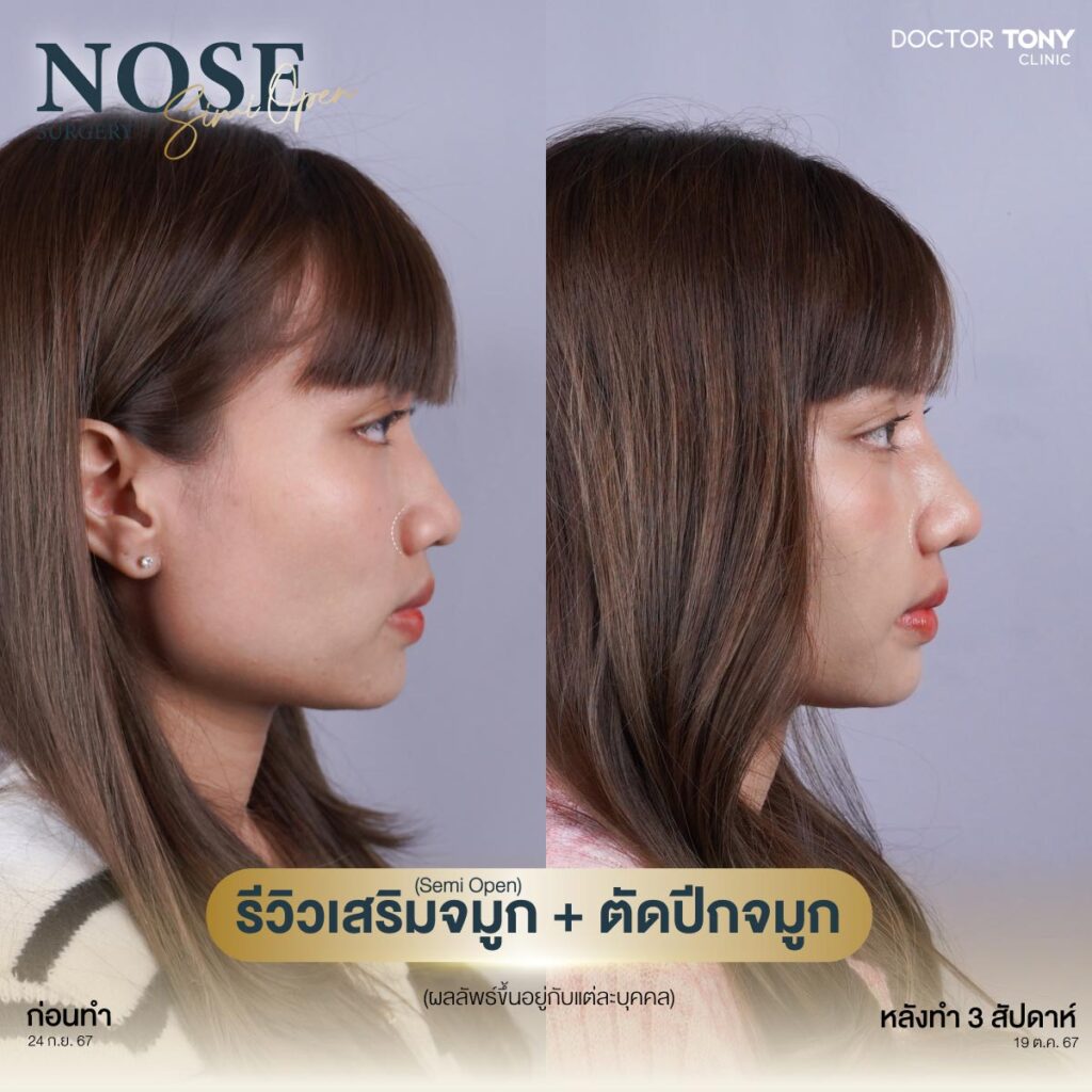 รีวิว ตัดปีกจมูก