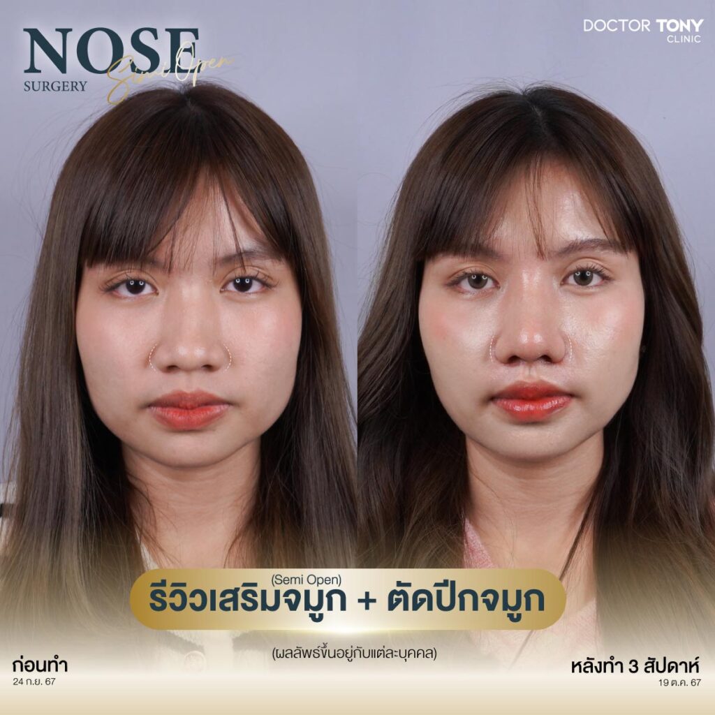 รีวิว ตัดปีกจมูก 2